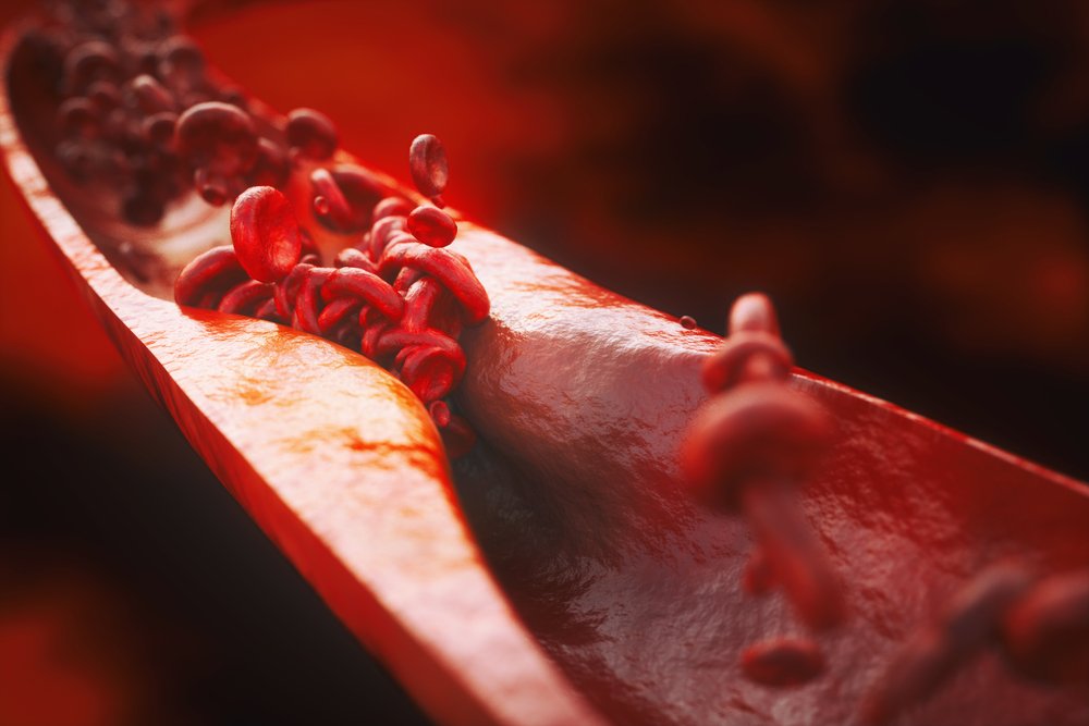 3D medical illustration showing red blood cells flowing through a partially clogged artery, representing arterial plaque buildup and cardiovascular disease.